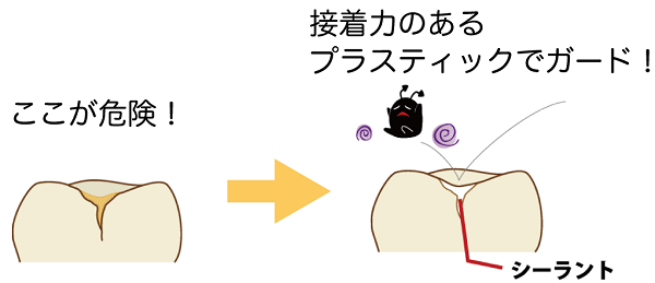 シーラントで予防歯科