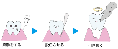 抜歯の流れ