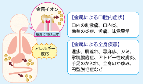 銀歯で金属アレルギーに メタルフリーなら池下さくら歯科