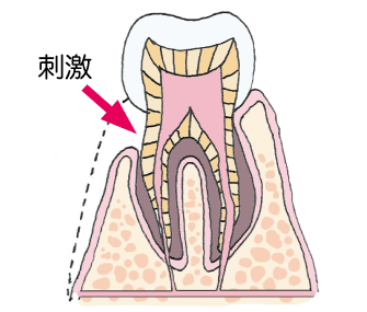 歯がしみる原因とは 意外に知らない知覚過敏の原因と対策