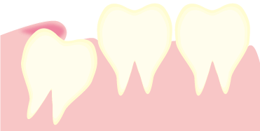 親知らずについて 千種区歯医者なら池下さくら歯科