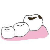 歯に穴ができている