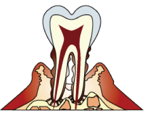 歯ぐきからの出血は歯周病のリスクあり！？